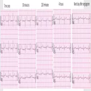 ECG Hyperacute T Progression